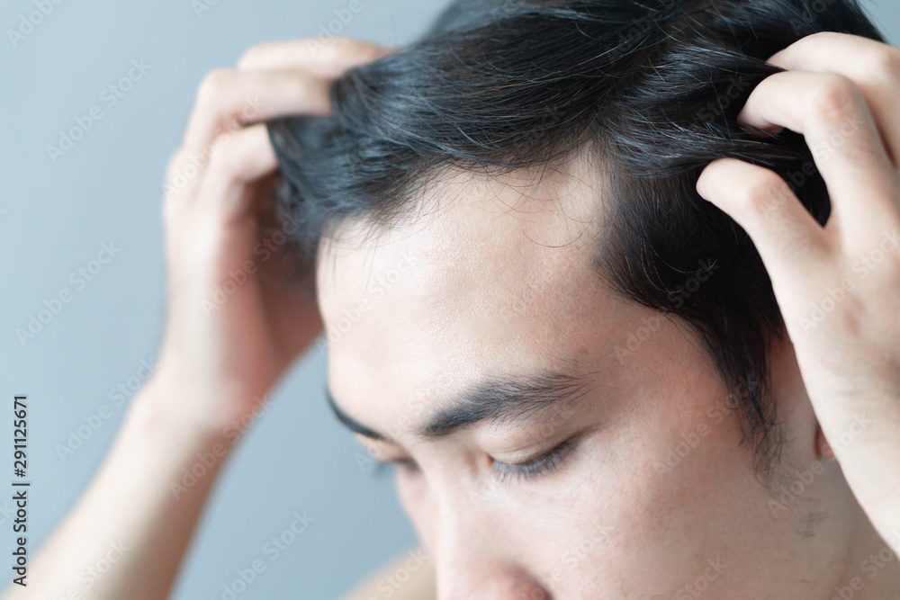 Young man serious hair loss problem for health care medical and shampoo product concept, selective focus Young man serious hair loss problem for health care medical and shampoo product concept, selective focus