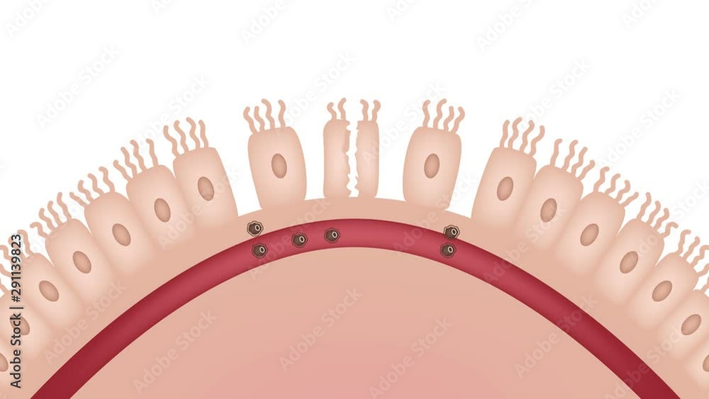 Celiac disease Small intestine lining damage. good and damaged villi ...