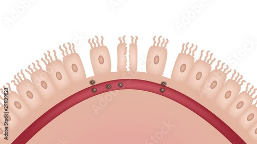 Celiac disease Small intestine lining damage. good and damaged villi . leaky gut progression / graphic animation