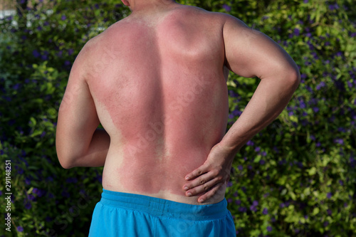 Sunburned painful back man from the sun. Painful sunburn red skin on holiday.