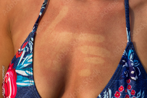 Sunburned painful woman from the sun. Painful sunburn red skin on holiday.