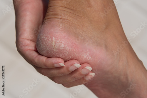 Woman treat cracked hard skin on the heel in the bathroom.