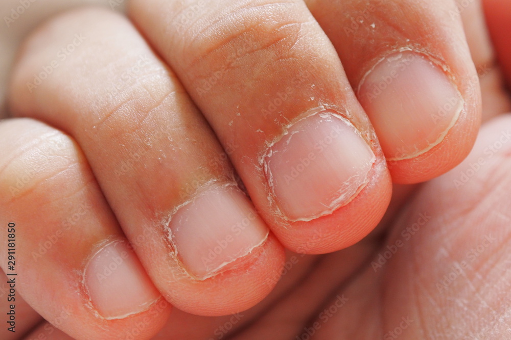 Closeup of fingers and nails bitten of a man. Health and medical concept Closeup of fingers and nails bitten of a man. Health and medical concept