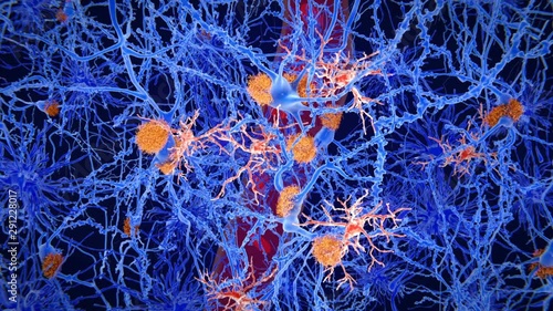 Animation of microglia cells (pink) in the brain of a person with Alzheimer's disease photo