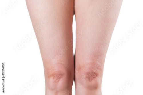 Flabby skin on female legs, older woman's knees isolated on white background