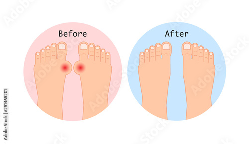 Bunion before and after operation. Vector illustration.