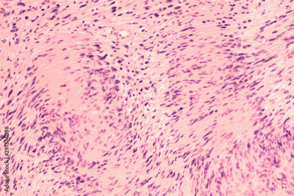 Photomicrograph of a schwannoma, a benign soft tissue tumor of peripheral  nerve sheath, with characteristic nuclear palisading and "Verocay bodies".  Stock Photo | Adobe Stock