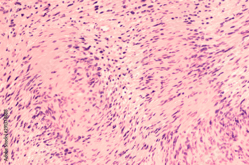Photomicrograph of a schwannoma, a benign soft tissue tumor of peripheral nerve sheath, with characteristic nuclear palisading and 