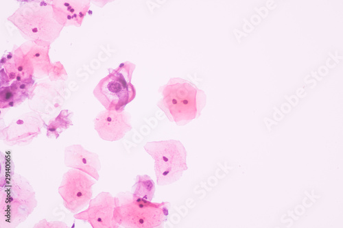 View in microscopic of abnormal human cervix cells.Koilocyte cell criteria of Human Papilloma Virus (HPV) infection from pap smear slide.Cytology and pathology laboratory department.Magnification 400X photo