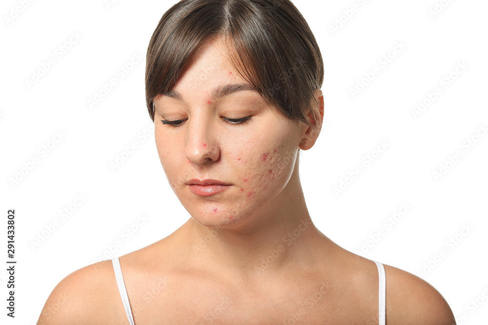 Young woman with acne problem on white background Young woman with acne problem on white background