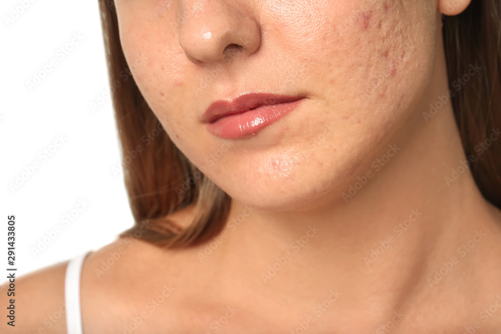 Obraz premium Young woman with acne problem on white background, closeup