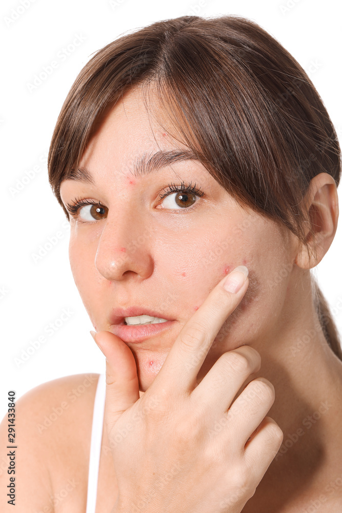 Young woman with acne problem on white background