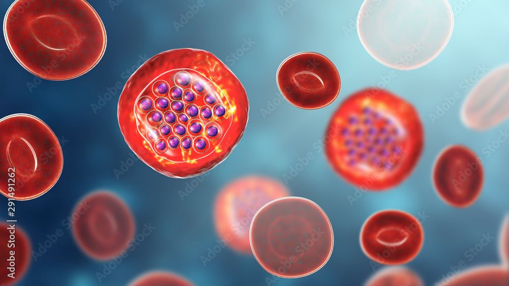 The malaria-infected red blood cells. 3D illustration showing malaria ...