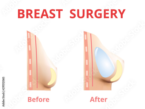 Breast implant before and after, Plastic surgery, 3D Realistic design Vector.