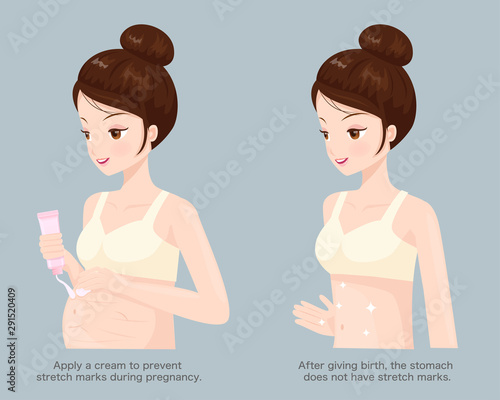 Eliminate stretch marks from pregnancy