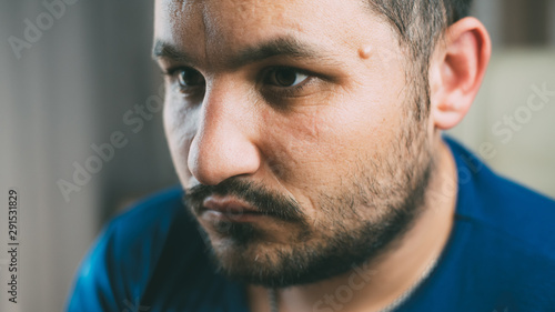 Photography The tumor on the face of men near his temple , Lipoma Wen or zit, ugly acne, der