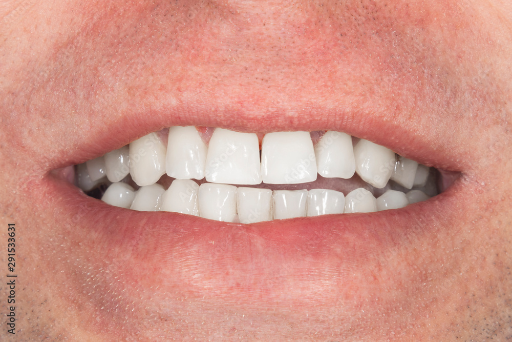 Obraz premium teeth whitening close-up macro. Hygiene of the human oral cavity after admission to the dentist