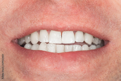 teeth whitening close-up macro. Hygiene of the human oral cavity after admission to the dentist
