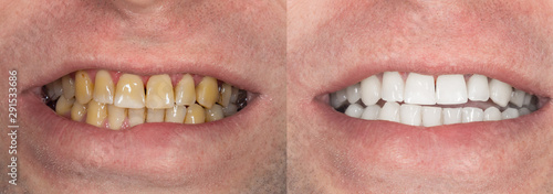 smoking, plaque on teeth