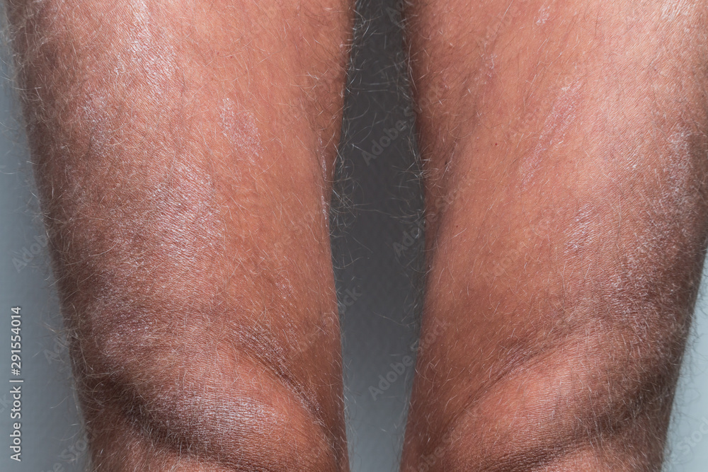 Large plaque parapsoriasis on caucasian man legs Large plaque parapsoriasis on caucasian man legs