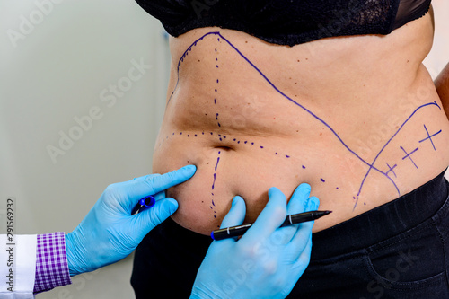 The doctor drawing lines on the patient’s skin