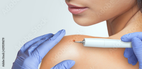 A beautician removes a large ugly mole from a woman’s shoulder. photo