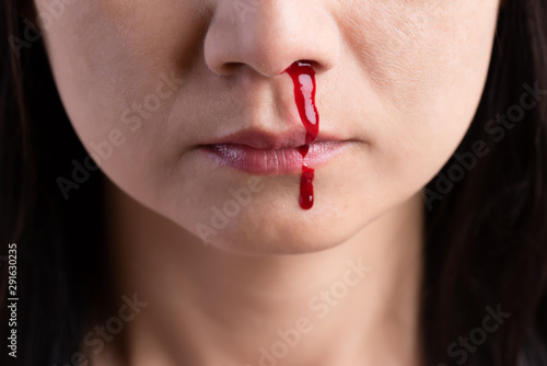 Konstfotografi Nosebleed , a young woman with a bloody nose