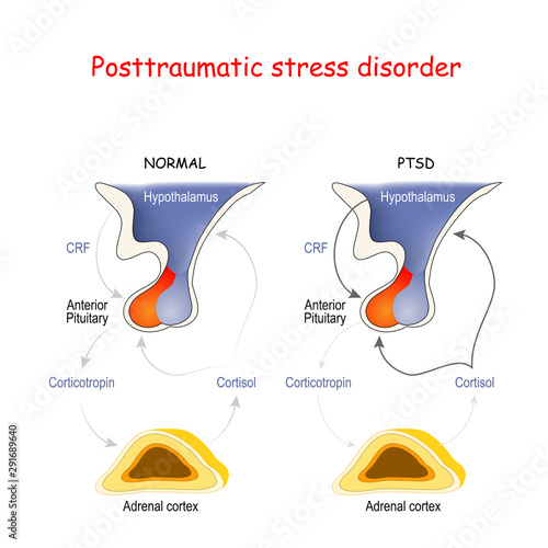 Posttraumatic stress disorder