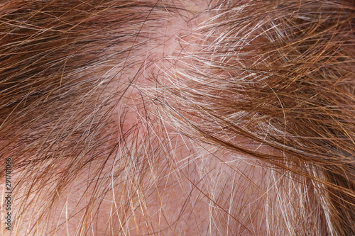 Sore greasy skin and sparse gray hair on the head of a senior  elderly woman
