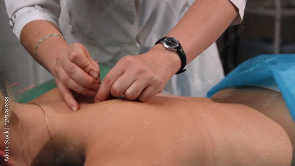 Dry needling.Acupuncture.Reflexologist puts needles on a woman's back.Traditional Chinese medicine.Trigger point therapy Dry needling.Acupuncture.Reflexologist puts needles on a woman's back.Traditional Chinese medicine.Trigger point therapy