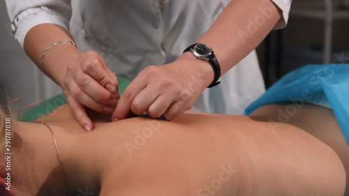 Dry needling.Acupuncture.Reflexologist puts needles on a woman's back.Traditional Chinese medicine.Trigger point therapy