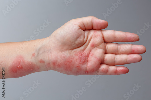 Fotografie Shingles, Zoster or Herpes Zoster symptoms on arm