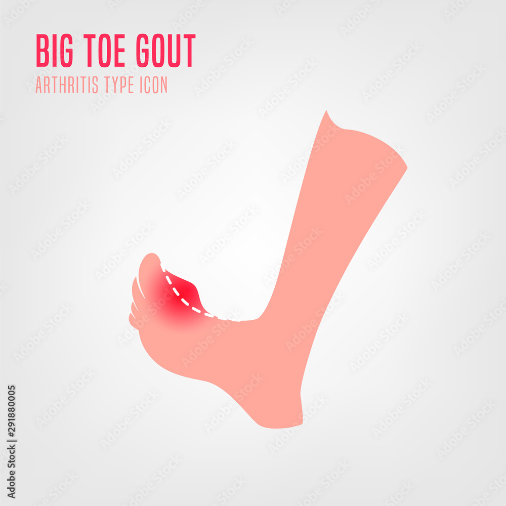 Obraz premium Gout arthritis icon