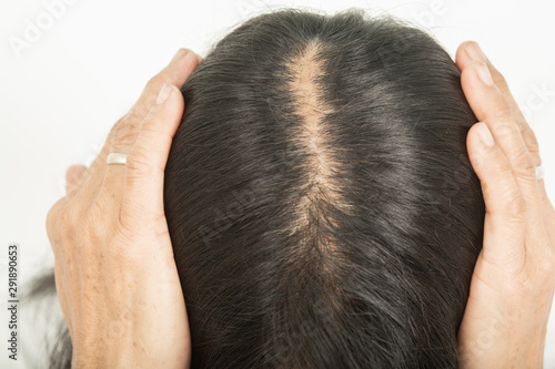 .Scalp and thin hair, hair removal Thin hair and scalp and broken hair