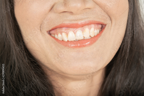 Abnormal teeth Irregularities teeth .Abnormal teeth and Yellow teeth and stains