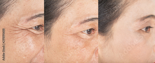 Wrinkles on the eyes.  and before and after melasma  and freckles  facial treatment on face  skin Problem