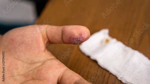 An infection wound with pus inside the thumb on the white bandage with blood stains. Hygiene, infected.