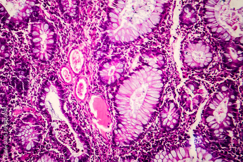 Villous colon adenocarcinoma, light micrograph, photo under microscope