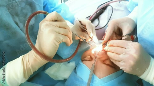 close up shot of the doctor's hand, who is engaged in rhinoplasty of the nose in the hospital