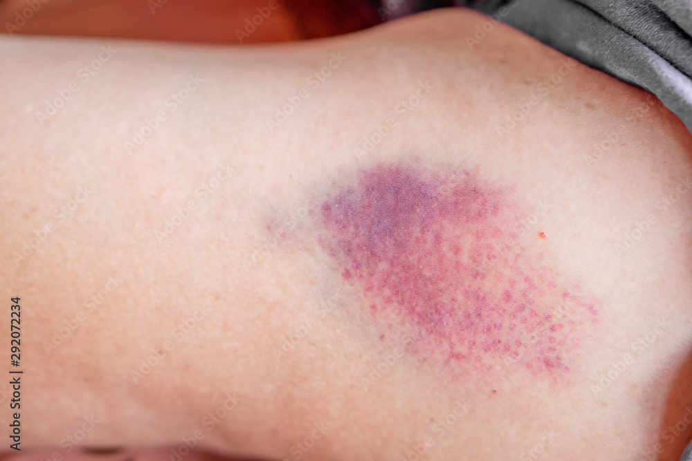large injection bruised on woman arm closeup large injection bruised on woman arm closeup