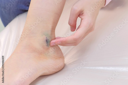 Woman patient touching suture after leg surgery on ankle in hospital, closeup view. Recovery, rehabilitation, therapy and treatment after surgery. Removal of ankle hygroma.