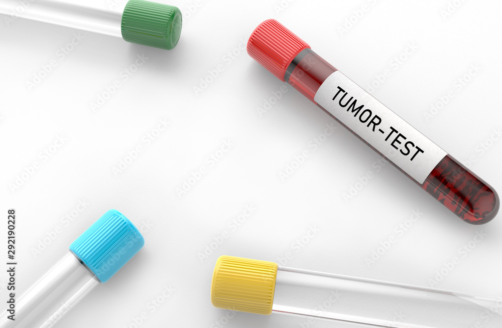 Tumor test analysis result blood test tubes are in the table Concept of the tumor of the diagnosis in a patient in blood tests Tumor test analysis result blood test tubes are in the table Concept of the tumor of the diagnosis in a patient in blood tests