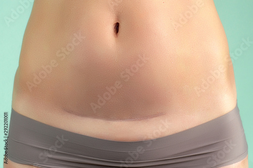 Close up of a caesarean section scar in a woman. Health and childbirth.