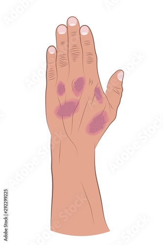 Psoriasis on human hand on white background . Vector illustration
