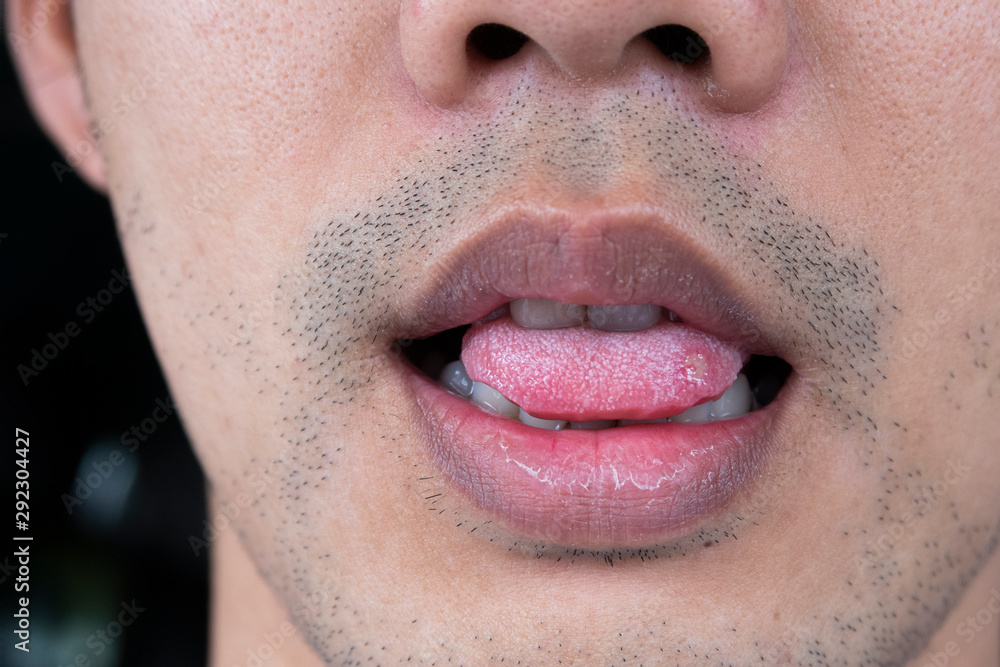 Fototapeta premium Close-up Sore tongue