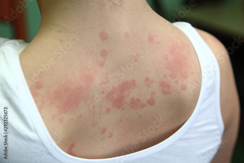allergic dermatitis photo