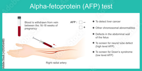 Alpha-fetoprotein AFP test. Use Analysis by AFP level. to detect liver cancer, and use to screen for down’s syndrome. photo