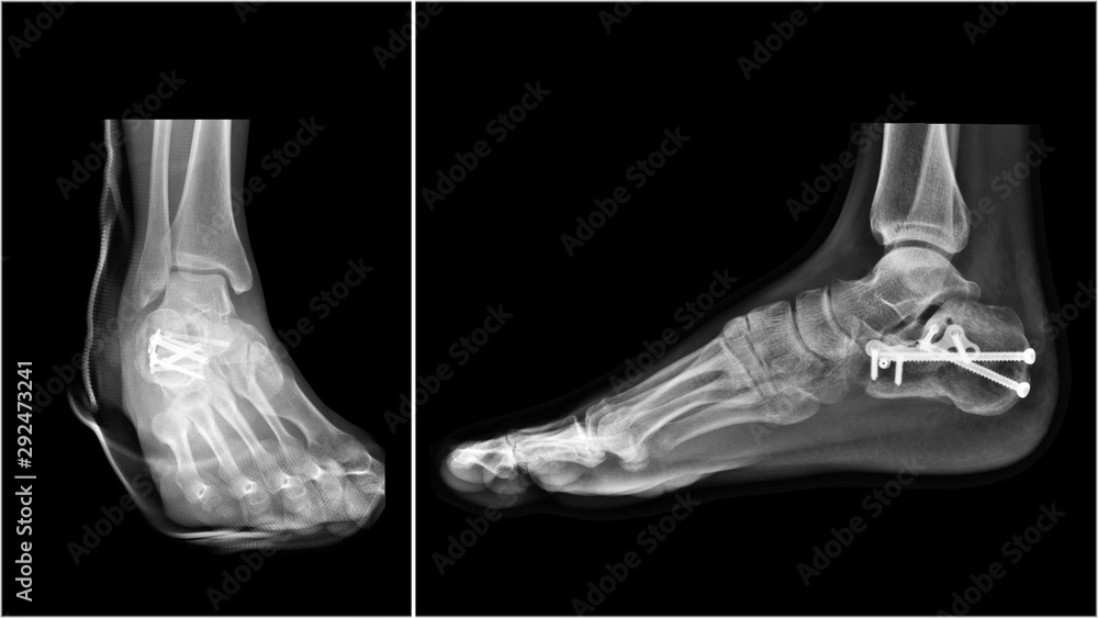 film-ankle-x-ray-radiograph-showing-heel-bone-broken-calcaneus