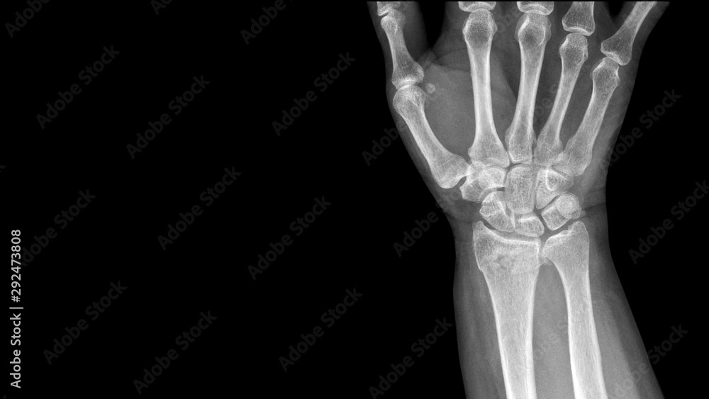 Film X ray wrist radiograph show distal forearm bone broken ( distal end radius fracture). The