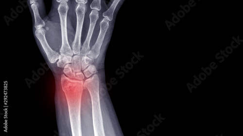 Film X-ray wrist radiograph show lower end of forearm bone broken (distal end radius fracture) from falling. Highlight on broken site and painful area.  Medical imaging and technology concept photo